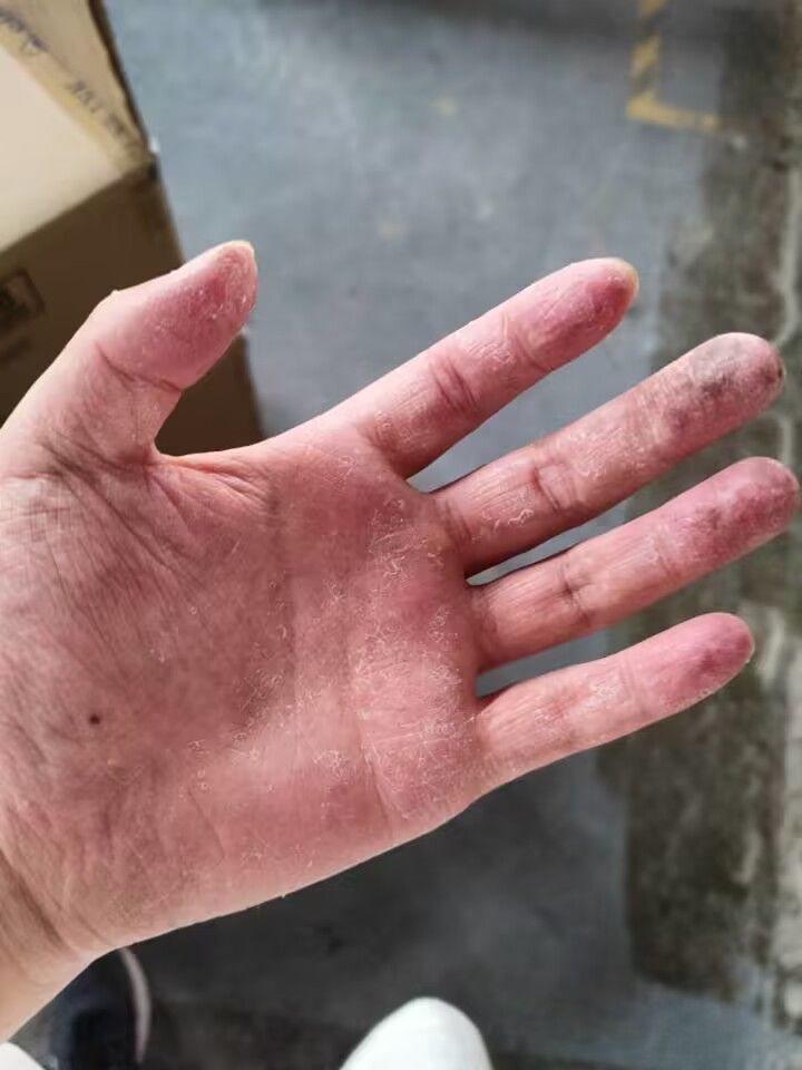 打暑假工手都磨烂了截图