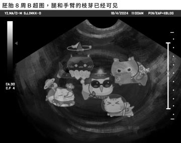 怀了5保胎， 预产期明天！