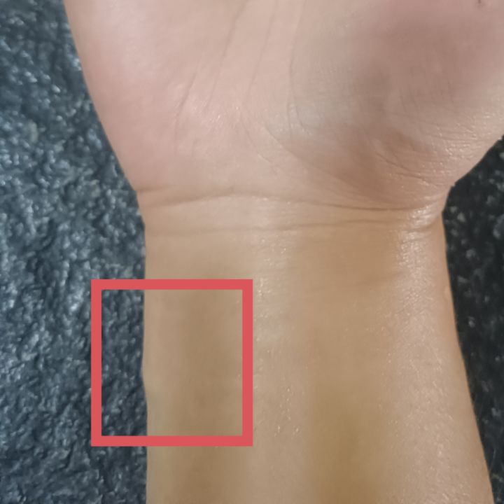 这个肿胀是怎么回事儿?🤔截图
