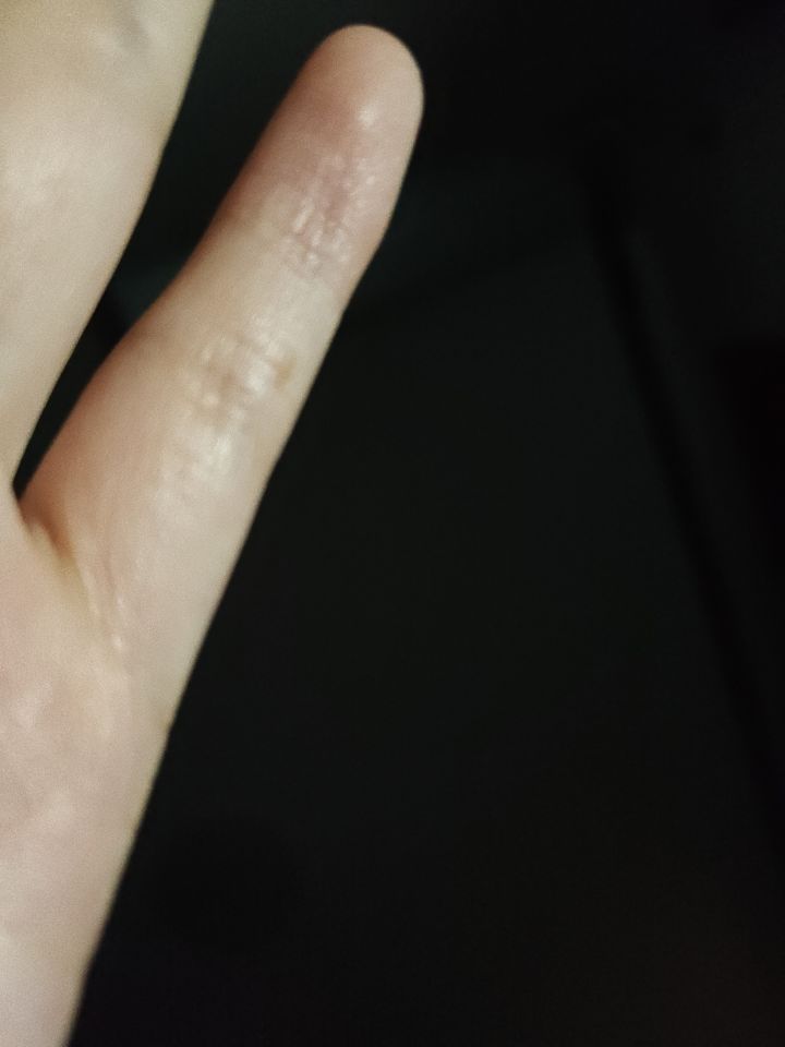 有没有医学生啊,小指头上有个类似痣的东西截图